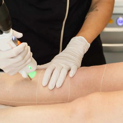 Découvrez l'expertise de l'épilation et du détatouage par laser à Marseille